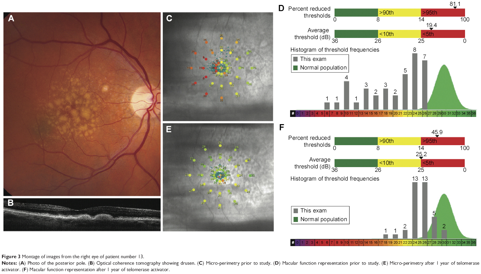 Evaluation of an oral telomerase activator for early age-related macular degeneration - a pilot study