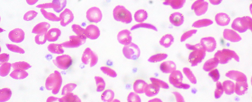 Scientists Reverse Sickle Cell Disease for the First Time Using Gene Therapy