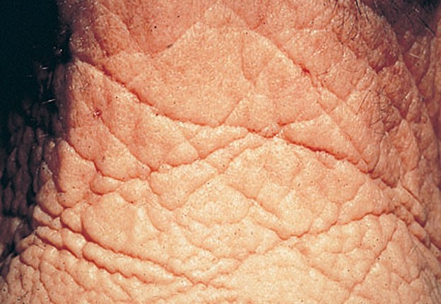 Common antioxidant could slow symptoms of aging in human skin